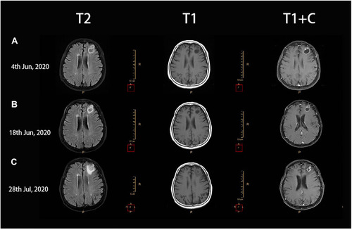 Figure 4 Brain contrast-enhanced MRI. (A) mixed solid-cystic lesions in the left frontal lobe, suggesting brain abscess/malignancy. (B) left frontal ring-like enhancement lesions, considering brain abscess, smaller than the previous one. (C) smaller left frontal ring-like enhancement lesions, enlarged scope of edema.