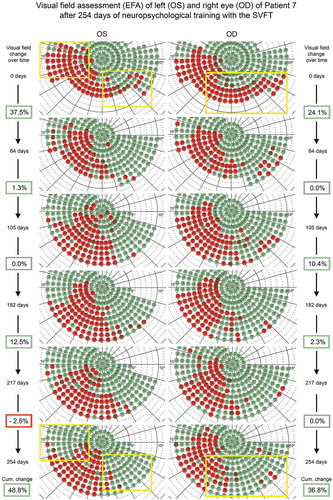 Figure 2. Illustration of visual field tests (inner 10°) – conducted with our perimetric “Eye Tracking Based Visual Field Analysis” (EFA) – after 217 days of therapy with our “Salzburg Visual Field Trainer” (SVFT) of Patient 7 suffering from quadrantanopia and visual neglect symptomatic. Red dots represent stimuli not detected, green dots represent stimuli detected during perimetric assessment. One stimulus stands for approximately 0.75° of visual angle. Note the obvious improvements in stimulus detection – marked by the yellow rectangles – at both sides of the respective visual field defects. Data analysis (by total numbers of undetected stimuli based on baseline assessment) shows total visual field enlargement of 48.8% (OS) and 36.8% (OD) and gradual improvement especially during the first 64 days of therapy (also see Figure 3)