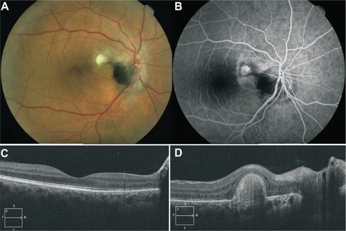 Figure 2 Post treatment fundus color image, fluorescein angiography and optical coherence tomography findings.