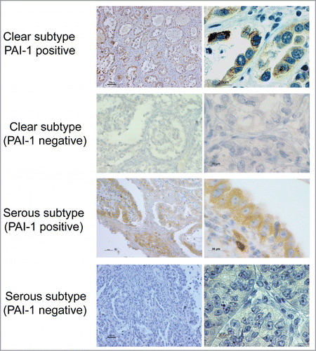 Figure 5. PAI-1 expression in different histological subtypes of human ovarian carcinoma. Cancer tissues were stained with PAI-1 antibody. Representative examples of PA1-1-positive and -negative immunostaining in tissues of ovarian clear cell and serous adenocarcinoma, respectively (original magnification: left panels, 200×; right panels, 1,000×). Scale bars represent 50 or 100 μm (left panels), and 20 μm (right panels).