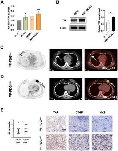 Figure 1. 18F-FDG imaging shows that YAP overexpression is associated with glycolysis in BC. (A) qRT-PCT assay to measure YAP levels in BC cells. (B) The protein levels of YAP. (C, D) Typical 18F-FDG PET/CT imaging of patients with low (C) or high (D) SUVmax levels. (E) IHC assay assessment of YAP in patients with low and high SUVmax. Typical IHC images of YAP, CTGF, and HK2 in patients with low and high SUVmax. Data are mean ± SD for triplicate experiments. *p < 0.05, **p < 0.01, ***p < 0.001.