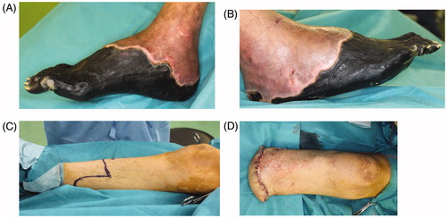 Figure 3. The necrotic tissue expanded from the fingers to the right heel. Amputation was performed at the level of the lower leg, and the wound was closed primarily. (A)(B) The condition before amputation, (C) amputation design, (D) condition after suturing.
