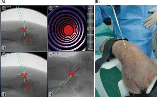 Figure 3. Pin insertion using 2D fluoroscopic navigation. (A) The computer screen displays three views of the wrist: lateral, oblique, and anteroposterior. The surgeon first determines the ideal trajectory of the screw along the scaphoid axis in all 3 planes. The exact position of the screw can then be reproduced with the navigated drill guide. The view at lower right enables alignment parallel to the planned implant position to be maintained in all available projections. Pin insertion can now begin. In this case, the direction of the drill was first imitated by using a calibrated pointer applied to the scaphoid tubercle. (B) Application of the calibrated pointer to the scaphoid in the cadaver.