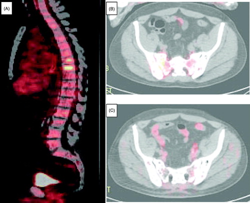 Figure 1. PET/CT scans of the involved bones. (A) Spine at the time of diagnosis. (B) Pelvis at the time of diagnosis. (C) Pelvis after 7 months of myeloma-directed therapy.