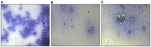 Figure 5 Histologic analysis of ascitic cells in animal models. A) Smear showing numerous clumps of pleomorphic cells with hyperchromatic nuclei that are malignant cell clumps (tumor controls). B and C) Smears show very few pleomorphic cells with hyperchromatic nuclei and significant reduction in malignant cell clumps in comparison with A (tumor, treated group).