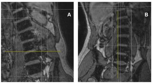 Figure 10 Rotation with Standard Cut Lines (Rot-S). (A) demonstrates coronal image with subject rotation and standard axial cut line (yellow line) without endplate adjustment. (B) is a coronal image with subject rotation and standard parasagittal cut line (yellow) without adjusting for position.