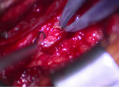 Figure 3 The lower margin of the tumor compared to normal nerve tissue.