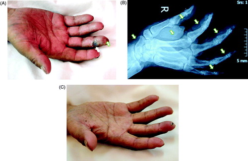 Figure 1. The finger affected by CUA in the uremic patient on Tibetan Plateau before and after treatment. (A) The appearance of affected finger: Focal ulcer on distal interphalangeal joint of the middle finger in his right hand, with pale and hardened distal finger. (B) X-ray image of the right hand showed extensive arteries calcification of arteries of the fingertips (indicated by white arrows). (C) Two months after treatment, the finger ulcer healed, with only tiny crust.