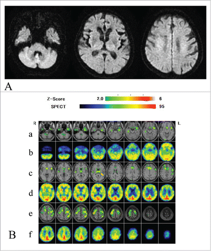 Figure 1. Diffusion weighted MRI and eZIS analysis of 99mTc-ECD SPECT images. Diffusion-weighted MRI of the brain 10 months after the onset of symptoms (A), and easy Z score (eZIS) analysis of 99mTc-ECD-single photon emission computed tomography (99mTc-ECD-SPECT) images 12 months after onset (B). The eZIS analysis of 99mTc-ECD-SPECT images revealed decreased regional cerebral blood flows (rCBF) in the thalami (arrow). Lanes (a, c, and e) of panel (B) show fusion images of MRI and 99mTc-ECD-SPECT Z score images. A higher Z-score indicates lower rCBF (Z>2.0 means significantly decreased rCBF compared with normal controls. The Z-score scale of 2 to 6 is indicated by the green to red (lower rCBF) color gradient. Lanes (b, d, and f) show plain SPECT images. The red color in the plain SPECT images indicates higher rCBF; the blue color indicates lower rCBF.
