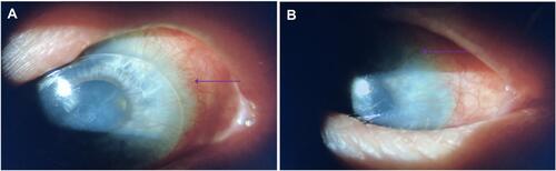 Figure 2 Limbal stem cell deficiency in the right (A) and left (B) eye. Arrows point to neovascularization and conjunctivalization of the cornea. Whorled keratopathy, obscured limbal architecture, subepithelial haze, and conjunctival hyperemia are also present bilaterally.