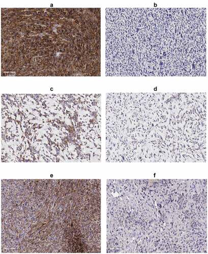 Figure 1. IHC of PD-L1; (a) UPS case with high PD-L1, (b) UPS case with low PD-L1, (c) MFS case with high PD-L1, (d) MFS case with low PD-L1, (e) OSA case with high PD-L1 and (f) OSA case with low PD-L1. All immunohistochemical-stained images were taken at the equivalent of x20 magnification
