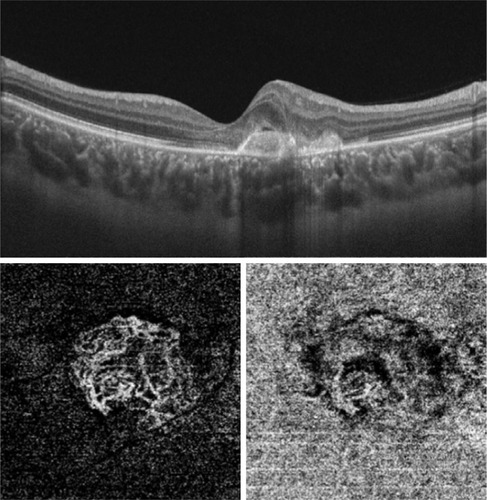 Figure 6 Upper, SS-OCT of the left eye of a 30-year-old female with MFC shows hyper-reflective double hump lesion causing disorganization of the outer retina and is associated with intra-retinal fluid. The lesion is located entirely above the RPE, which indicates type II CNV. Lower, “en face” SS-OCTA image captured at the level of the outer retina (left) and choriocapillaris (right) in a 3×3 mm field. The outer boundaries of the lesion and the arborizing pattern of the neovascular network are best delineated in the outer retina projection, whereas in the choriocapillaris projection the boundaries of the lesion are indistinguishable from the surrounding background in several locations.
