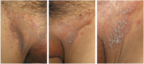 Figure 1 (a–c) Multiple gray-white or dark red hyperkeratotic papules on a brown background on the bilateral groin. On closer examination, the hyperkeratotic papules had a verrucous appearance, some of which had coalesced.