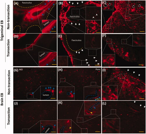 Figure 5. Trigeminal transection reduced brain and trigeminal perivascular EB. (A–C) EB in non-transection trigeminal vessel, perineurium and fasciculus. (D–E) Trigeminal transection reduced EB in perivascular spaces or tissues, in the perineurium and fasciculus. (G–I) EB distributed into perivascular spaces in medulla, pons and pia mater. (J–I) trigeminal transection reduced the EB around the vessel in medulla, pons and pia mater. White arrows: perineurial EB; blue arrows: perivascular EB. The bar is 50 μm, 20×; (B) and (E) 40×.