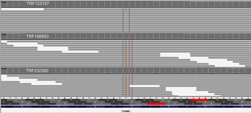 Figure 3 Integrative Genomics Viewer screenshot demonstrating next generation sequencing data (FoundationOne) from three specimens (TRF123157, specimen from October 2015; TRF166853, from June 2016; TRF232300, from May 2017). The specimens from June 2016 and May 2017 both show a CTNNB1 (NM_001904.4) c.133_134delTCinsGT, p.S45V dinucleotide substitution; however, this variant is not seen in the original specimen from October 2015.