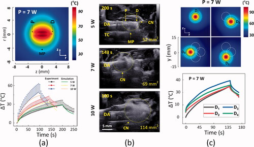 Figure 3. Quantitative evaluations on thermal responses of ex vivo pancreatic tissue to CILA at various power levels: (a) numerical simulations on spatial development of temperature in tissue after single CILA at 7 W for 143 s (top; MP = measured point at r = 5 mm; P and D = proximal and distal ends) and experimental validations of interstitial temperature elevations (ΔT) at MP measured by thermocouple during single CILA at various power levels (bottom; 5, 7, and 10 W), (b) cross-sectional US images of tissue captured at various power levels (5, 7, and 10 W) during CILA (DA: diffusing applicator; TC: thermocouple; CN: coagulation necrosis), and (c) numerical simulations on temperature distributions in tissue for four sequential CILAs (top) and real-time monitoring of temperature elevations (ΔT) by individual CILA at 7 W for 143 s (bottom; D1∼D4: inserting positions of DA). Note that the values in right bottom corners in (b) represent the estimated volumes of CN.
