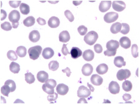Figure 1. Peripheral blood film shows normocytic to microcytic hypochromic red cells with circulating erythroblasts and irregularly shaped cells (May-Grunwald–Giemsa, ×1000).