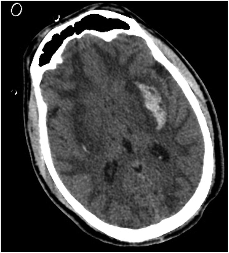 Figure 2. Case 2 brain CT showing hypodense confluent lesions in superficial white matter, frontal, occipital lobes and putamen consistent with acute toxic edema and infarction as well as bilateral putaminal hemorrhagic changes (left ≫right).