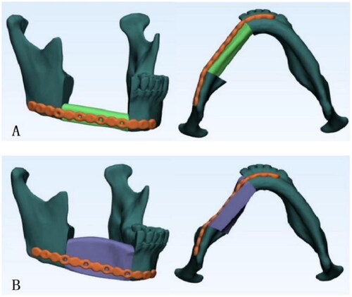 Figure 4. Conventional surgical plates matched to the mandible reconstructed with free fibula flap (A) and deep circumflex iliac artery flap (B).