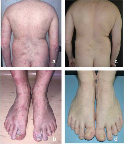 Figure 1. Clinical psoriasis aspect before (a, b) and after 156 weeks (3 years) of treatment with secukinumab (c, d) in a patient affected by bipolar disorder with delusion episodes.
