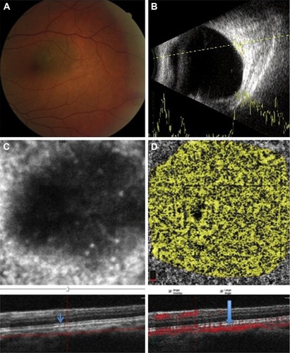 Figure 1 A case with a small choroidal nevus in the posterior pole of the left eye with some small drusen over the lesion.