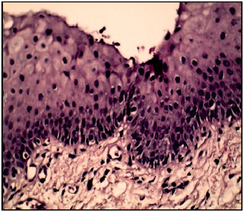 Figure 9. Showing disappearance of epithelial dysplasia after 6 weeks of curcumin treatment.