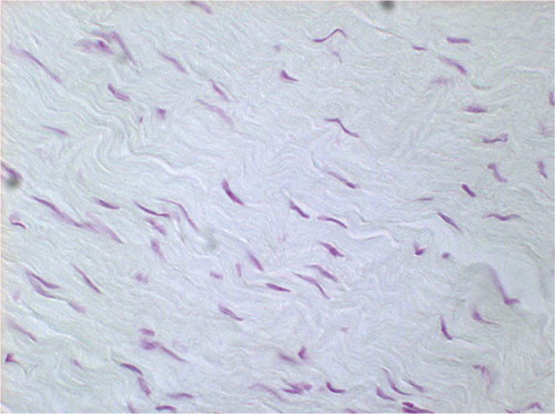 Figure 2. Feulgen staining at 3 weeks after radiofrequency treatment, permanently immobilized. Cellularity appears to be slightly increased (not significant) (original magnification: × 750).