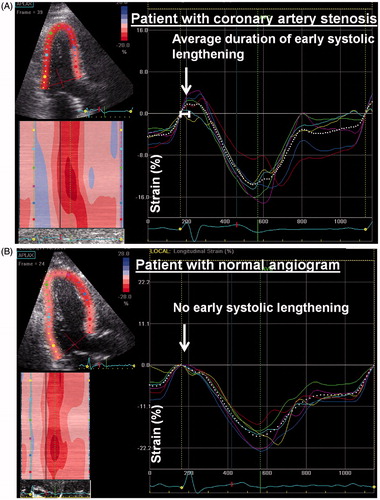 Figure 3. Strain curves from a patient with significant coronary artery stenosis (A). Strain curves from an individual without coronary artery disease (B). With permission from: Smedsrud et al.[Citation24]