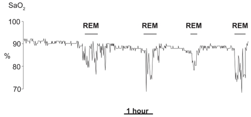 Figure 1 Recording of nocturnal oxyhemoglobin saturation during one night in a patient with COPD. Observe the prolonged desaturations during REM sleep stages.