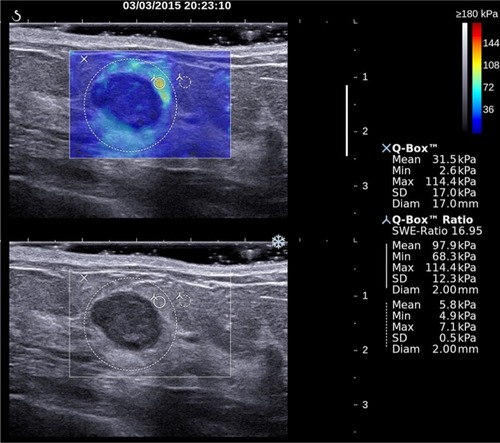 Figure 2 Two-dimensional grayscale ultrasound image (bottom) of a breast lesion in a 51-year-old female patient.Notes: According to morphological signs, the lesion was classified as probably benign (BI-RADS 3). Upper image shows the SWE semitransparent map that overlays the grayscale anatomical image. The largest dotted line circular region of interest (ROI) marked with an “X” was used to quantify global lesion stiffness values, reported on the right-hand side under “XQ-Box™.” The two smallest ROIs were used to calculate the elasticity ratio between the stiffest area within the lesion or surrounding stiffness halo and breast fatty tissue used as a reference. The SWE features of this lesion were suspicious for malignancy. Pathological outcome from breast biopsy was a mixed papillocarcinoma with mixed ductal carcinoma.Abbreviations: BI-RADS, Breast Imaging Reporting and Data System; SWE, shear wave elastography.