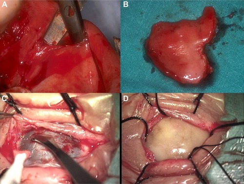 Figure 6 OOKP stage 1 – buccal mucosal graft preparation and transplantation.