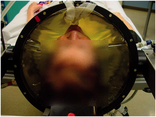 Figure 7. [Case 2] Patient during the test treatment. The HYPERcollar was originally designed to treat only patients with a tumour in the neck. For patients with a tumour in the head, we use sticky tape for comfort and respiration purposes.