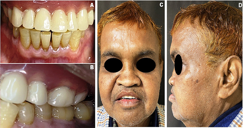 Figure 5 (A) Intra oral view showing zygomatic implant retained upper prosthesis against natural dentition. (B) Centric occlusion. (C) Frontal view after prosthesis in place. (D) Lateral view after prosthesis in place.