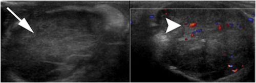 Figure 1 Testicular mass in cryptorchid testis: homogeneous diffuse intratesticular mass lesion with surrounding internal vascularity.