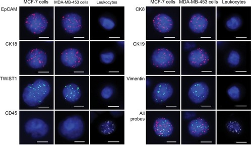 Figure 1 Expression of epithelial and mesenchymal markers in MCF-7 cells, MDA-MB-453 cells and leukocytes.