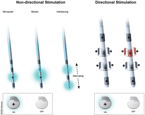 Figure 2. Common electrode stimulation configurations in DBS for Parkinson’s disease.