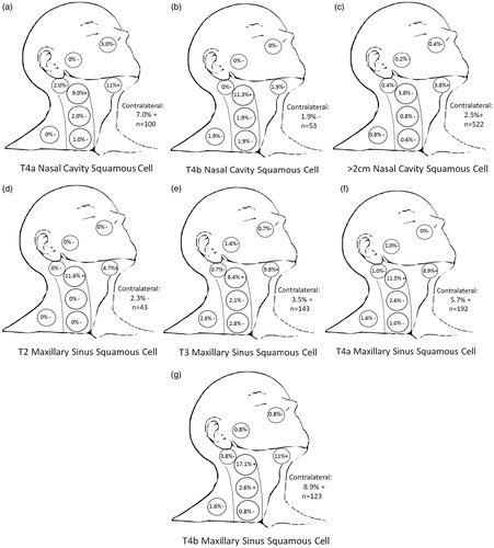 Figure 2. Nodal levels at clinically significant risk for (a) T4a SCC of the nasal cavity, (b) T4b SCC of the nasal cavity, (c) > 2 cm SCC of the nasal cavity, (d) T2 SCC of the maxillary sinus, (e) T3 SCC of the maxillary sinus, (f) T4a SCC of the maxillary sinus, (g) T4b SCC of the maxillary sinus. (+) denotes p < 0.05 compared to reference standard representing nodal levels to be included in treatment fields. (−) denotes p > 0.05 and therefore nodal levels commonly to be excluded from elective fields.SCC: squamous cell carcinoma.