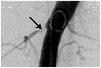 Figure 1. Renal artery angiography with gadolinium showing severe stenosis of the right renal artery (arrow).