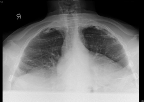 Figure 2 Nodular opacities in left upper zone periphery on chest X-ray (apical lordotic view).