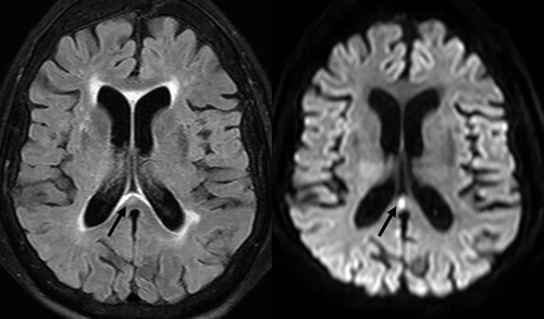 Fig. 1. Brain MRI examination at admission: unspecific subependymal hyperintensities corresponding to chronic leukoaraiosis are seen on left-sided FLAIR image together with a less common focus of hypersignal intensity within the splenium of the corpus callosum (arrow). Right-sided corresponding DW image in similar slice location shows disappearance of all chronic lesions but highlights the callosal lesion as an acute area of decreased water diffusivity (arrow).