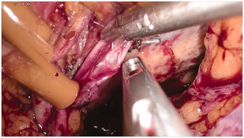 Figure 5. Manual repair of the vascular breaches through simple interrupted stitches with prolene 5/0.