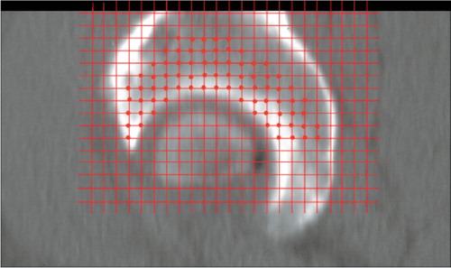 Figure 11. At first, the acetabulum was divided into three zones: The most joint-close 4 mm was defined as zone 1, the next 4 mm (above 4 to 8 mm) was defined as zone 2 and the next 12 mm (above 8 to 20 mm) was defined as zone 3. Secondly, a point counting grid with squares of 4 x 4 mm was placed on each CT image. Thirdly, where a point in the counting grid hit one of the zones in acetabulum, CT values were registered (red points). Points in cysts, osteophytes and screw were excluded.