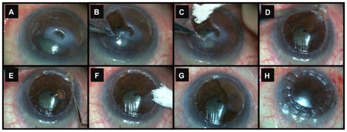 Figure 1 Consecutive images of a repeat manual deep anterior lamellar keratoplasty (DALK). During the procedure, there was continuous localized sweating of aqueous through Descemet’s membrane, but no microperforation was observed. (A) Central descemetocele due to cornea melting in uncomplicated DALK 7 months after surgery for a suspected neurotrophic central ulcer with descemetocele. (B) Sweating of aqueous through Descemet’s membrane and subsequent accumulation of fluid (arrow) over the recipient bed. The fluid prevents clear visualization of the surgical plane. (C) Recipient bed immediately after drying of the sweating. Now it is possible to see the surgical plane clearly and no microperforation is identified. (D and E) Consecutive images taken 15 seconds apart showing localized and continuous sweating through Descemet’s membrane (arrows). (F and G) Consecutive images after complete manual dissection. The former is immediately after drying of the recipient bed and the latter is after 2 minutes of continuous sweating of aqueous from Descemet’s membrane. The arrows indicate the specific location of Descemet’s membrane that sweats; perhaps an area with a nonvisible micron perforation. (H) Final image after successful redo DALK.