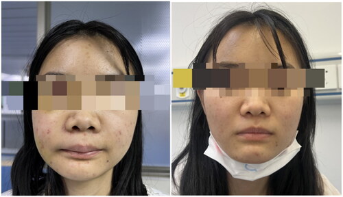 Figure 7. On the first postoperative day the patient showed swelling at the right nasolabial fold. And a postoperative image of the patient 3 months after the removal of the tumour. During the 3-month postoperative follow-up, this patient had a repeat nasal endoscopy (Figure 5) and CT of the paranasal sinuses (Figure 6), and no clinical or imaging signs of recurrence were found. The patient’s maxillofacial swelling and nasal congestion were significantly better than before (Figure 7). We will follow up on this case for a long time.