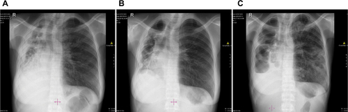 Figure S4 Chest X-rays of Patient 4 depicting (A) vast damage to the right lung with cavities, infiltrates, pleural disease, shrinkage, and destruction. Minimal damage to the left lung; (B) residual widespread damage to the right lung; and (C) right lung bullae and new pleural effusion. New infiltrates in left lung.