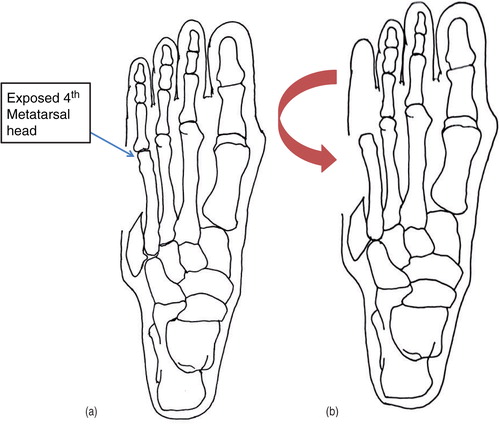 Fig. 3 (a, b) Filleted skin flap from lateral aspect of the fourth toe advanced laterally covering the exposed fourth metatarsal head.