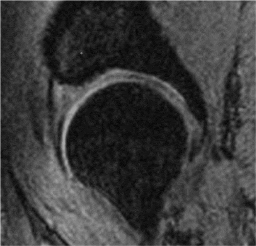 Figure 13. Sagittal MR image. In this patient it was difficult to separate the acetabular and femoral cartilage even though traction was applied.