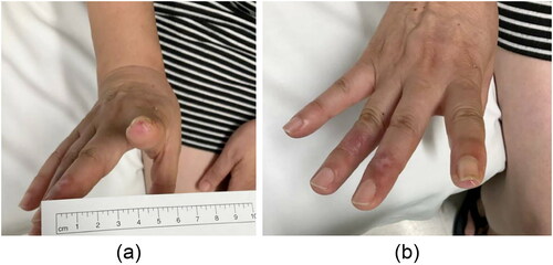Figure 4. Photograph demonstrating wounds to the (a) second digit and (b) third and fourth digits four weeks after initial exposure.