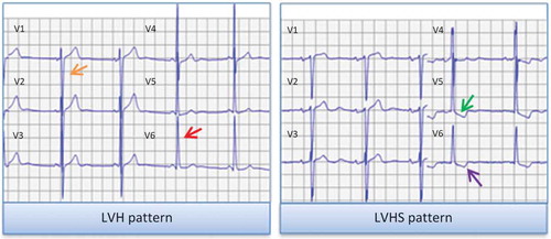 Figure 1. Graphical representation of LV hypertrophy and strain patterns on ECG. LV hypertrophy pattern was defined according to the Sokolow-Lyon voltage criteria, with the sum of the S wave depth in V1 (orange arrow) and tallest R wave height in V5 or V6 (red arrow) being higher than 35 mm. LV hypertrophy with strain pattern was defined as ST depression (green arrow) and asymmetrical T wave inversion (purple arrow) in the lateral leads (V5 and V6). ECG, electrocardiogram; LVH, left ventricular hypertrophy; LVHS, left ventricular hypertrophy with strain.
