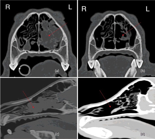 Figure 3. Pre-treatment and post-treatment CT images of case 2: (a) pre-treatment transverse; (b) post-treatment transverse; (c) pre-treatment longitudinal; (d) post-treatment longitudinal. Arrows mark the location of the tumour.